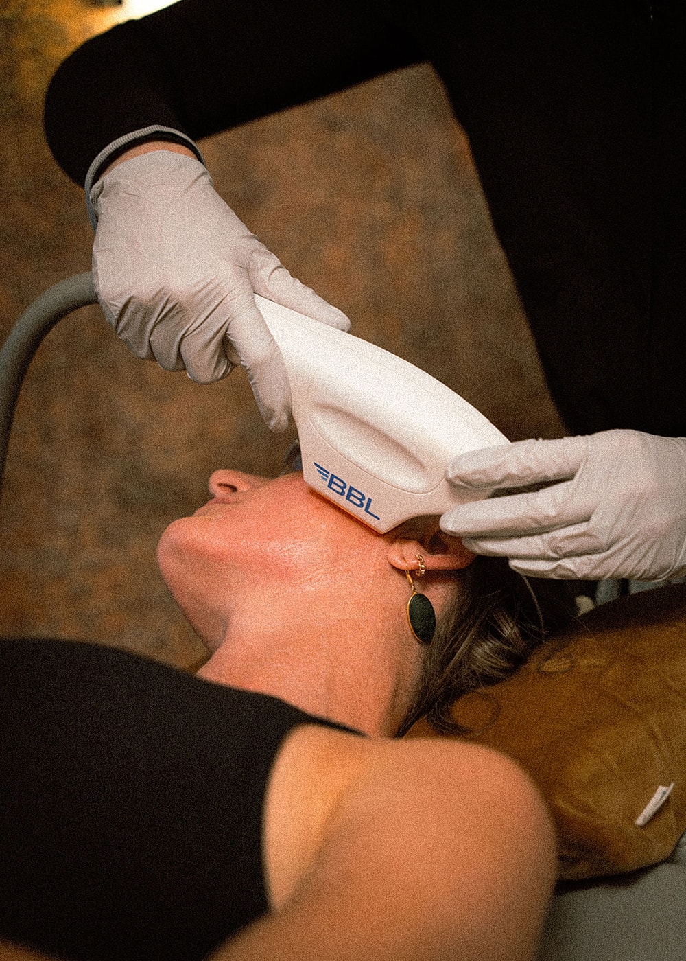 BBL treatment on a woman's face in clinic.